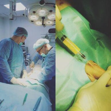Penis enlargement is possible with the help of surgery